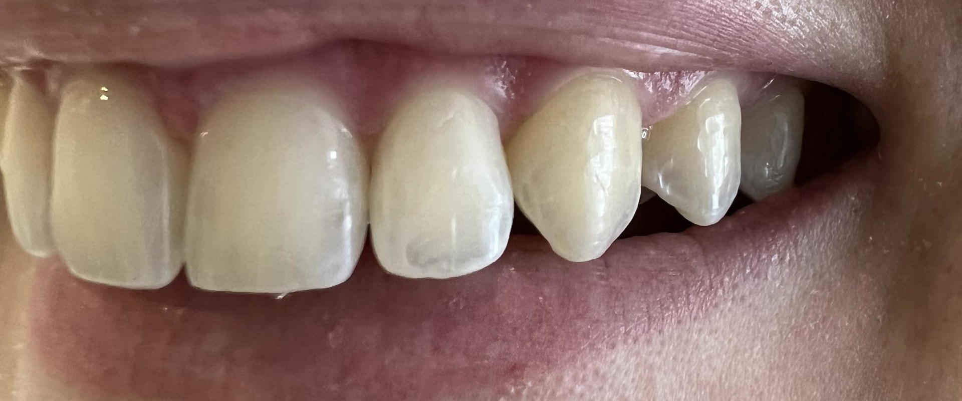 How invisalign attachments are removed?