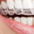 Which One is Faster: Braces or Invisalign?