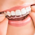 What is Invisalign and How Does it Work?