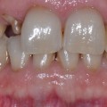What Teeth Do Attachments Go On For Invisalign Treatment?
