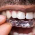 10 Things You Should Know Before Doing Invisalign Treatment
