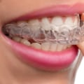 Is Invisalign Covered by Insurance? A Comprehensive Guide