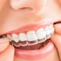 How Long Should You Wear Invisalign Braces For?