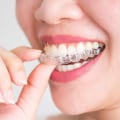 Can Invisalign Help Facial Asymmetry?