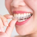 Can Invisalign Change the Shape of Your Face?