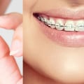 Do Orthodontists Prefer Braces or Invisalign?