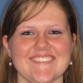 Will Invisalign Change My Face?