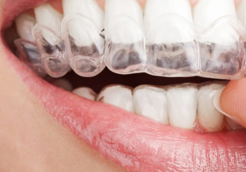 Can Invisalign Retainers Be Adjusted?
