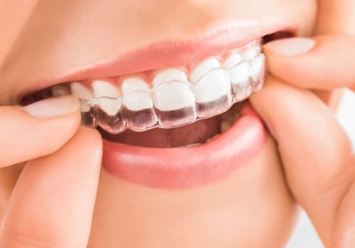 What is Invisalign and How Does it Work?