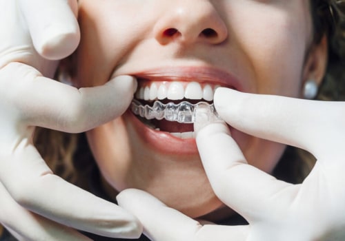 Do You Have to Wear Invisalign Forever?