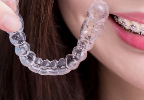 Braces vs Invisalign: Which is Better for Teeth Straightening?