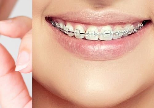 Is Invisalign Worse Than Braces? An Expert's Perspective