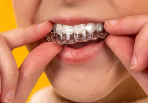 Is Invisalign Safer Than Braces? An Expert's Perspective