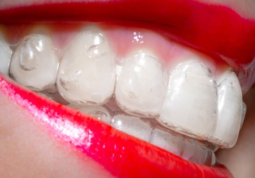Where Does Invisalign Ship From? An Expert's Guide
