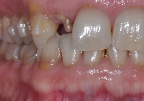 Do I Need Attachments for Invisalign Treatment?