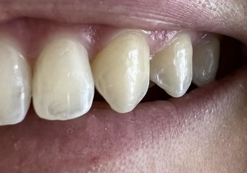 How to Safely Remove Invisalign Attachments
