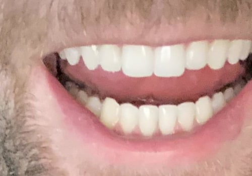 Are Invisalign Cleaning Glasses Safe and Effective?