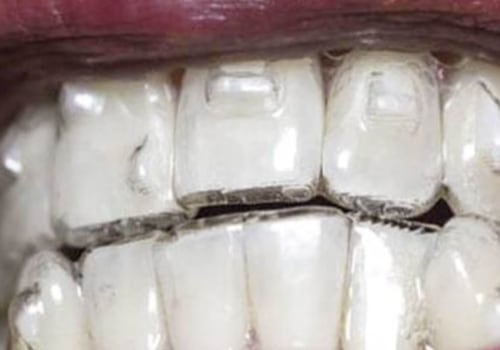 Do Invisalign Attachments Always Need to be Used?