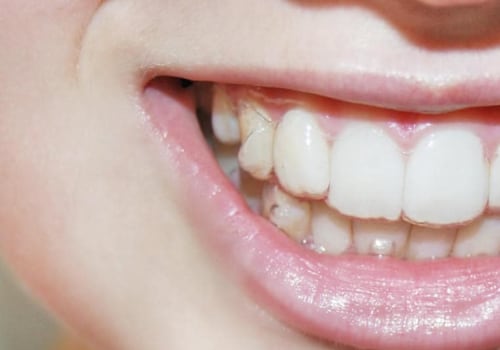 Do I Need Invisalign Attachments? An Expert's Guide