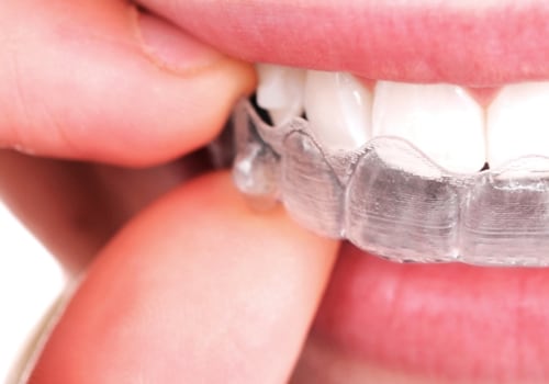 The History of Invisalign: From Stanford Students to Orthodontic Revolution