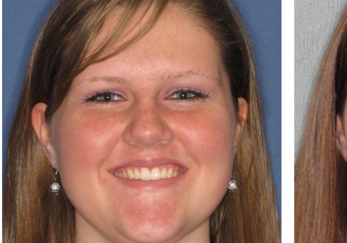 Will Invisalign Change My Face?